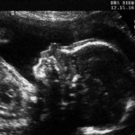 648x415_echographie-foetus-environ-cinq-mois-apres-conception